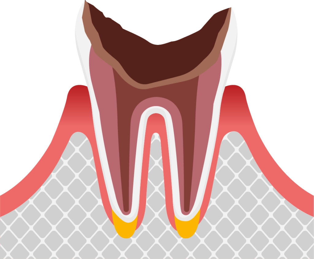 歯の根っこまで進行した虫歯