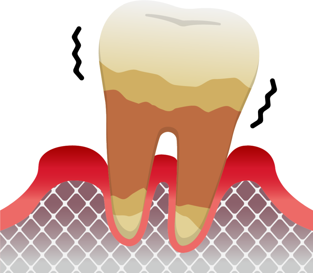 歯が抜ける寸前の歯周病