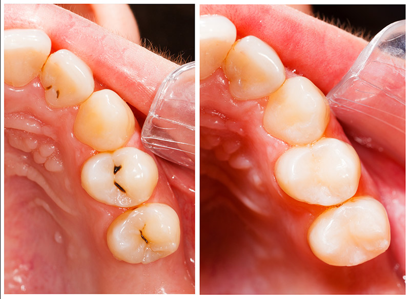 虫歯の治療前後
