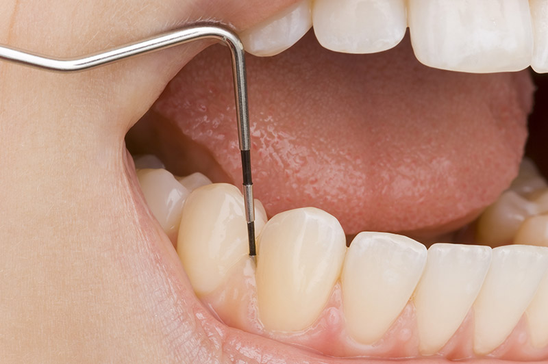 歯周病検査のイメージ
